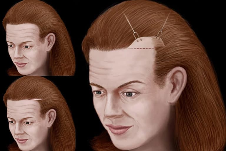 brow lift steps illustration