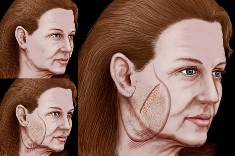 facelift steps illustration