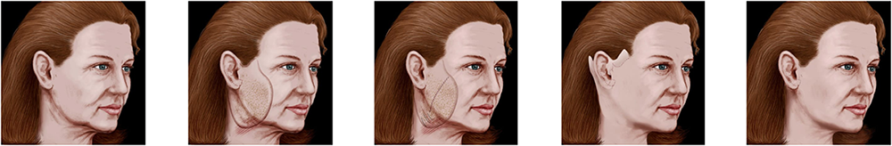 facelift steps illustration