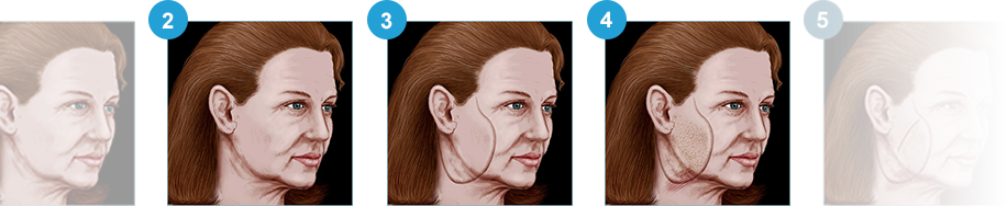 Facelift guide