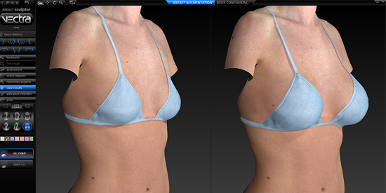 3-D Breast Imaging is Here  The Center for Cosmetic Surgery