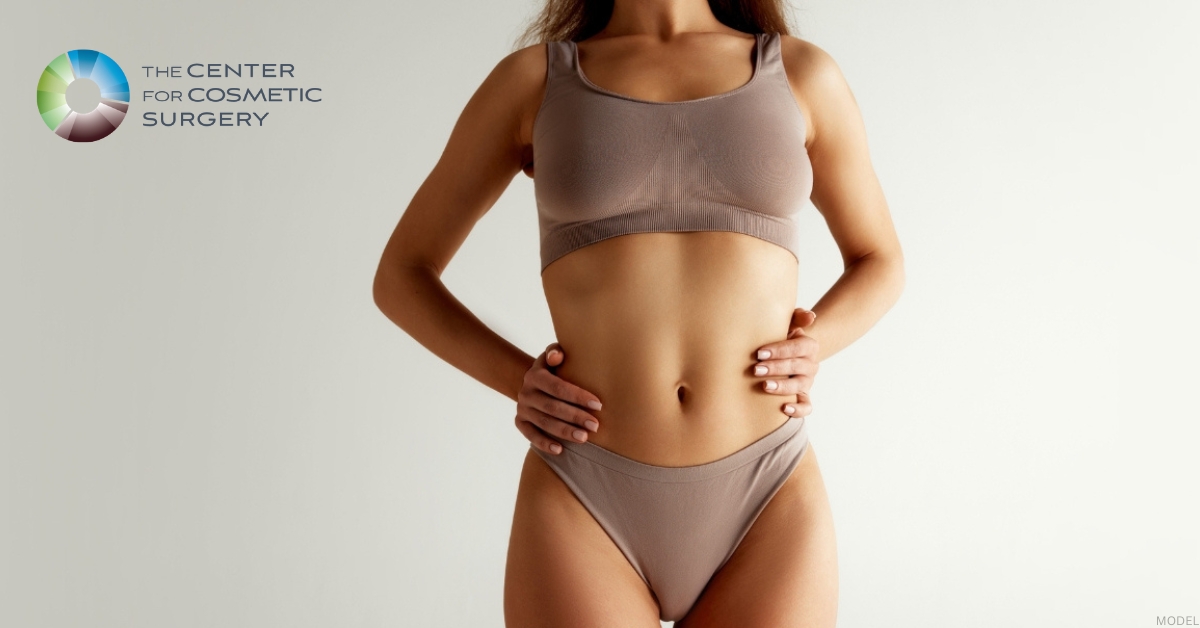 Woman showing abdominal contour after tummy tuck with diastasis recti repair (model).