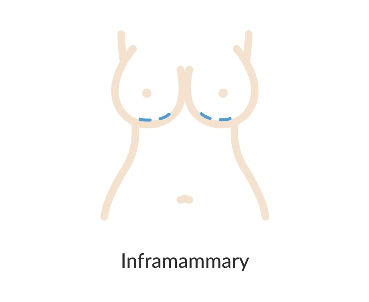 Inframammary Incision diagram