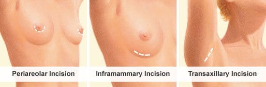breast augmentation incision options