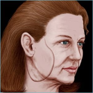 facelift guide - step 3