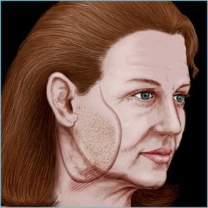 facelift guide - step 4