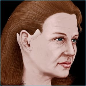 facelift guide - step 8