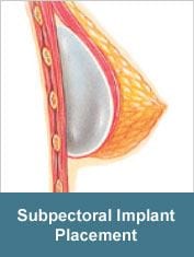 breast implant placement