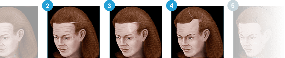 Brow lift guide