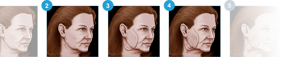 Facelift guide