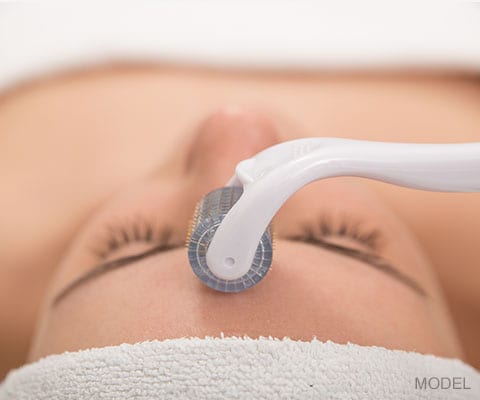 microneedling treatment