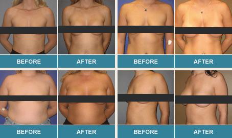 Patients before and after a breast lift
