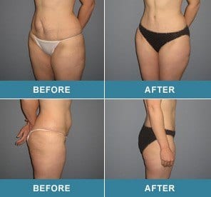 tummy tuck before and after photos