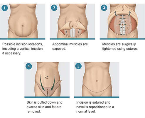 How Long Does a Tummy Tuck Last?  Parker Center for Plastic Surgery