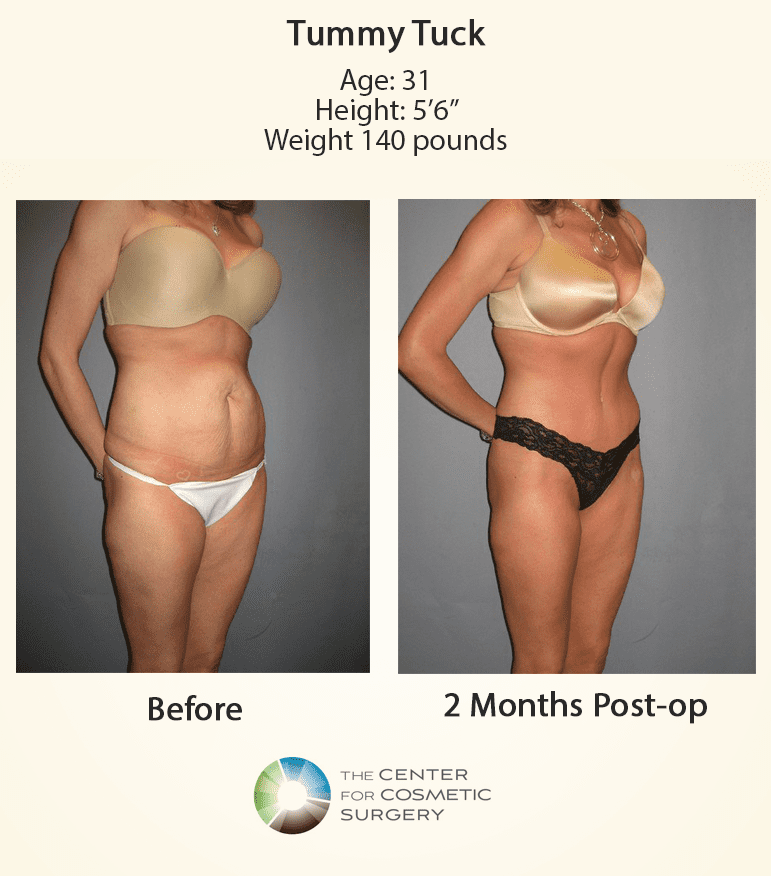 Tummy Tuck (3 Month Post op) Update!! Before and After In Pictures