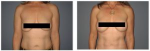 Patient is shown before and 14 months post op.