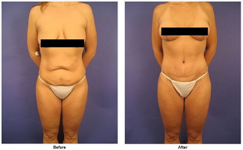 Tummy tuck before and after