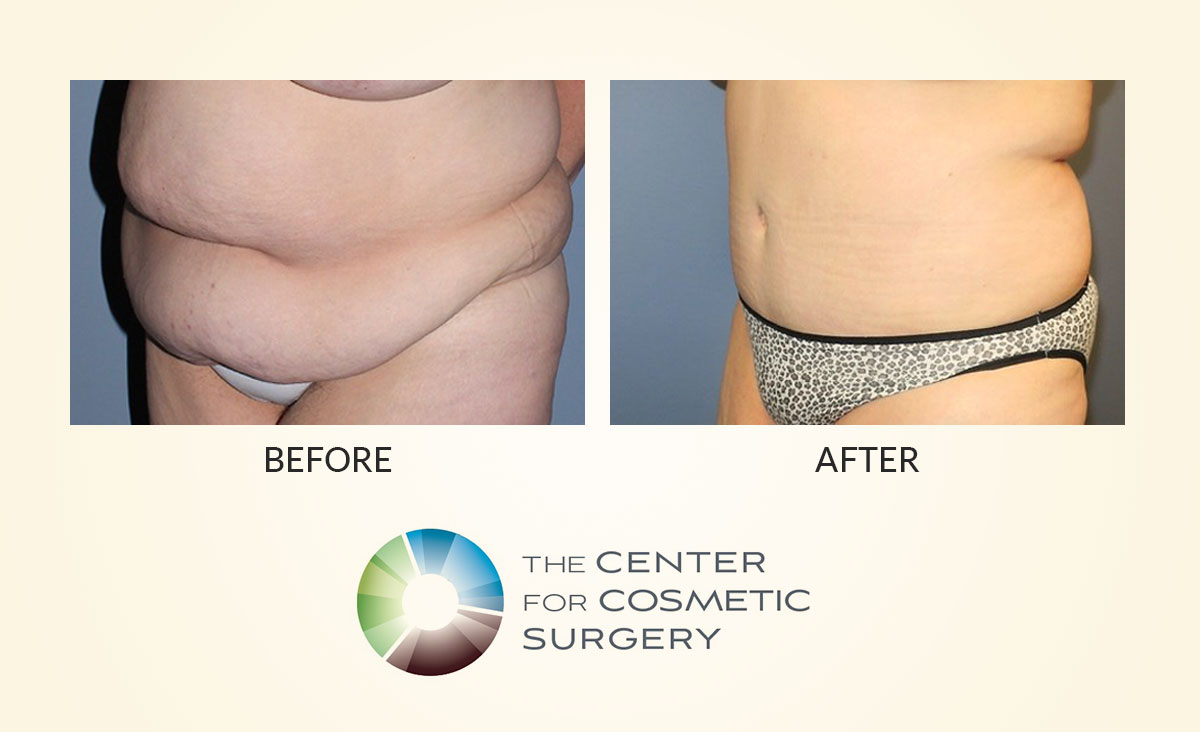 Tummy Tuck Before and After 