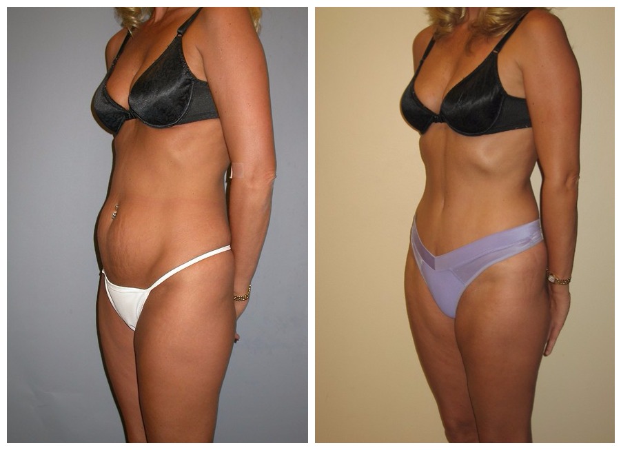 Tummy Tuck