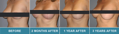 mastopexy before and after