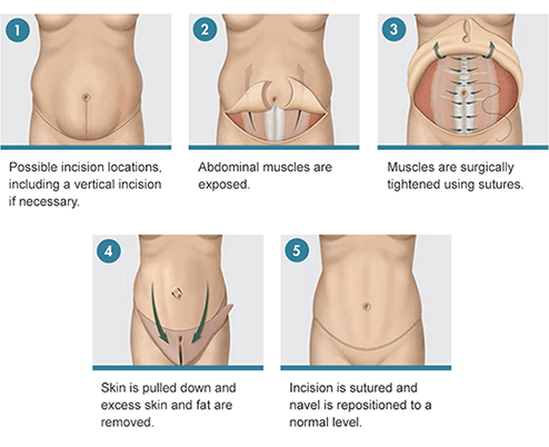 Tummy tuck incision infographic