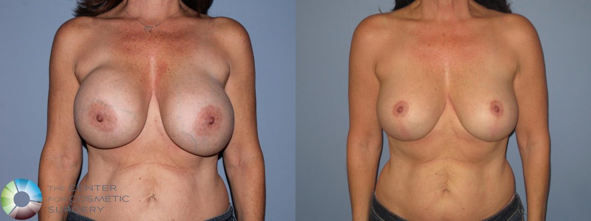 Picture of woman's bare torso showing her breasts with large implants and after implant exchange with smaller implants and a breast lift.