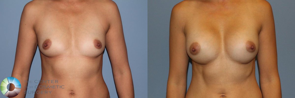 Woman's bare torso showing breasts before and after small implants.