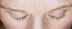 Woman's eyelashes before LATISSE® Eyelash Growth Treatment