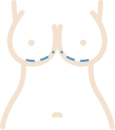 Illustration of a inframammary incision for breast implants