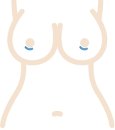 Illustration of a periareolar incision for breast implants