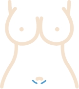 Illustration of a transumbilical incision for breast implants