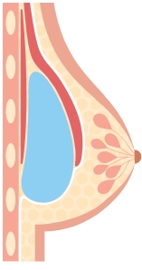 Illustration of a subpectoral implant placement