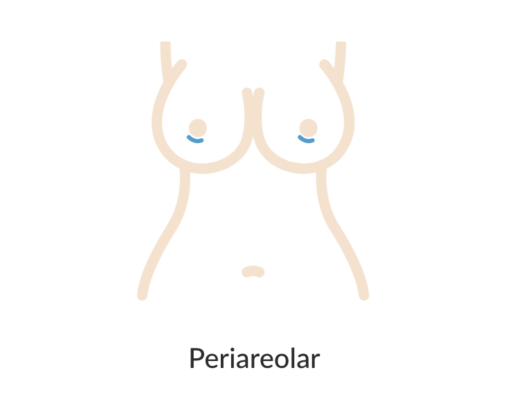 Breast augmentation periareolar incision diagram