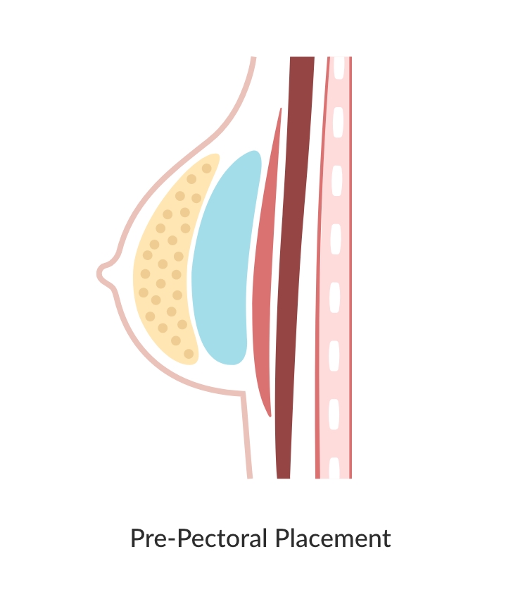 Pre-pectoral breast implant placement diagram