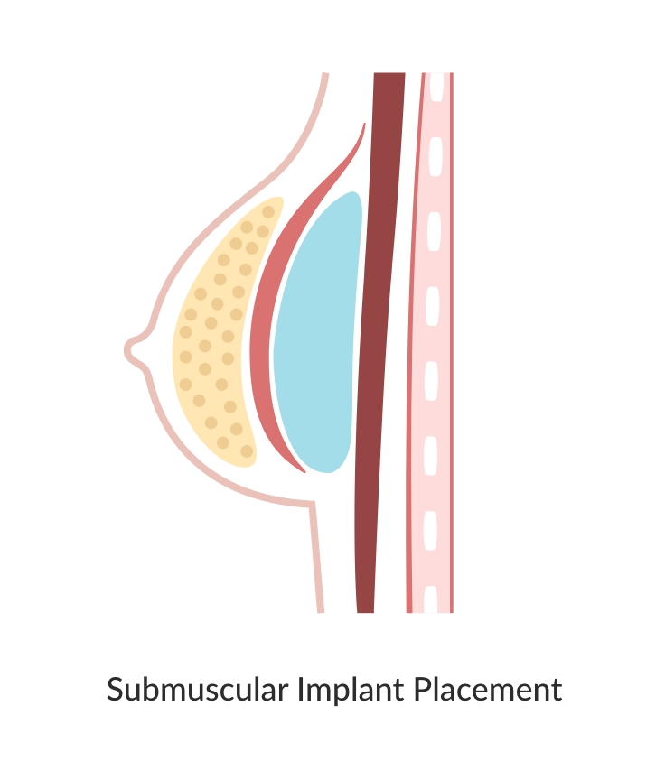 Breast augmentation submuscular implant placement diagram